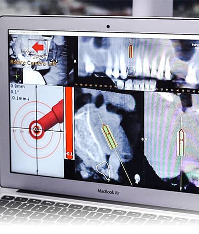 all-on-4-guided-surgery Navident guided all on 4 implant surgery