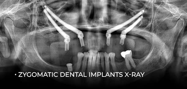cds patient celmira puga x-ray caption after getting her zygomatic dental implants in mexico
