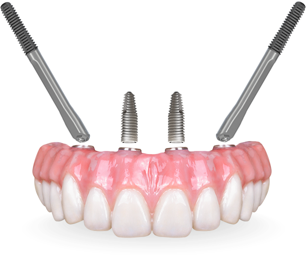 all on 4 prosthesis with zygomatic implants and regular implants