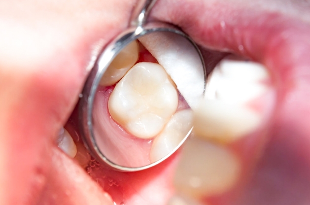 example of getting a composite filling after root canal therapy