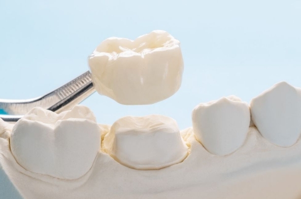 example of getting a dental crown after root canal therapy