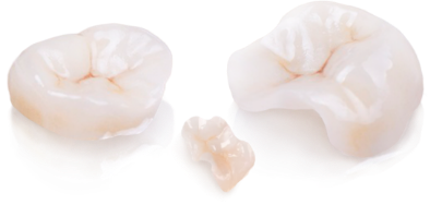 Inlays and Onlays cost in mexico