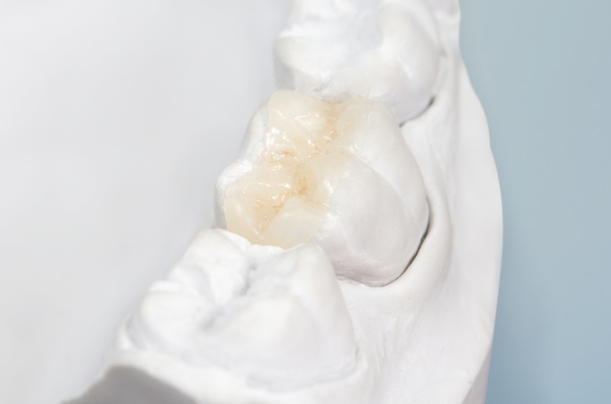 dental onlays inlays vs crowns
