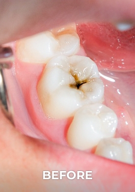 picture of molar tooth before being endodontically treated