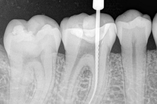 x-ray caption of non surgical root canal therapy done at Ocean Dental Cancun