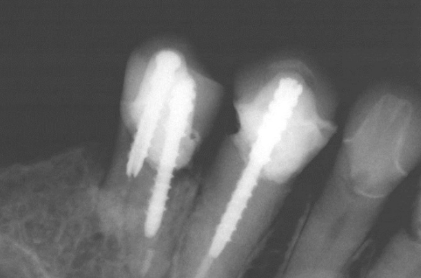 x-ray caption of post and core build up done at Ocean Dental Cancun