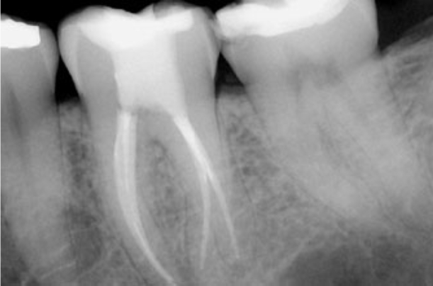 x-ray caption of root canal retreatment done at Ocean Dental Cancun