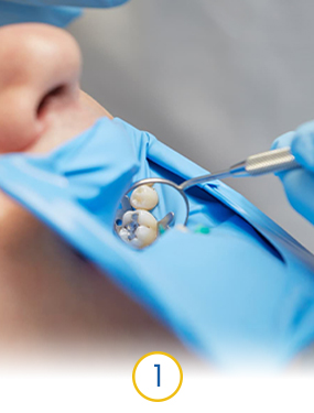 dentist in cancun performing pulp chamber access for root canal therapy