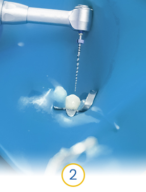 dentist in cancun removing infected tooth pulp in a root canal treatment