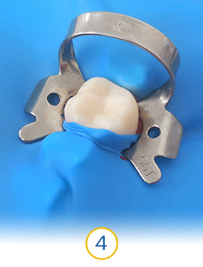 dentist in cancun placing a dental crown after a root canal therapy