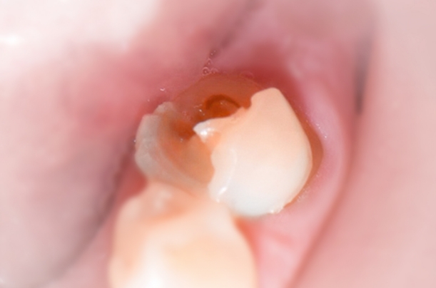 example of a damaged molar tooth where a dental crown is necessary