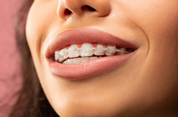 young female patient at dental work mexico with ceramic braces