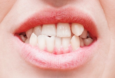 candidate for Invisalign in Mexico with a crossbite problem