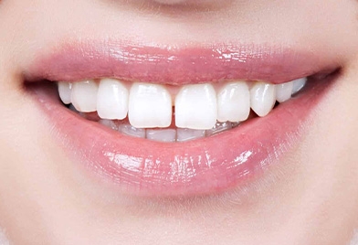 candidate for Invisalign in Mexico with diastema