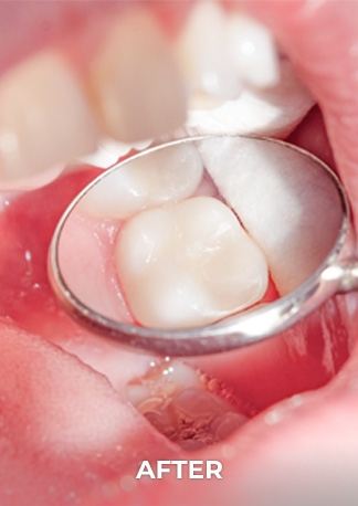 close up shot of Ocean Dental´s patient tooth after getting endodontics
