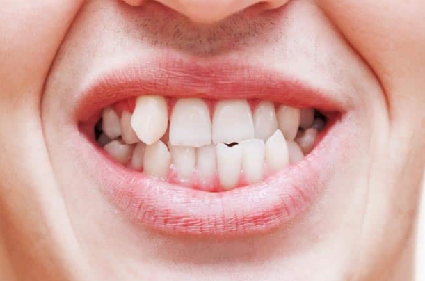 invisalign full treatment in Mexico for complex dental work