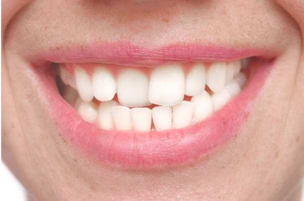 invisalign lite treatment in Mexico for simple dental work