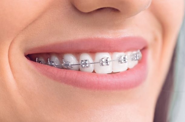 young female patient at dental work mexico with metal braces