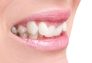 candidate for Invisalign in Mexico with an overbite problem