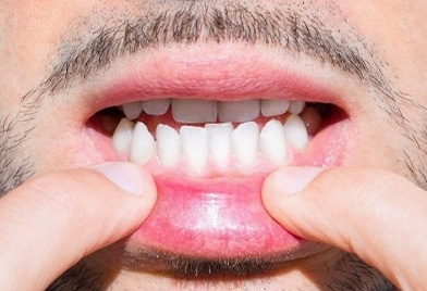 candidate for Invisalign in Mexico with an underbite problem