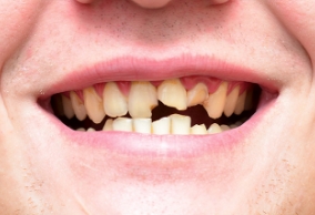 smile makeover candidate with several chips and cracks on his teeth