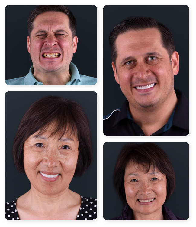 Full-mouth reconstruction before and after pictures from patients of Dental Work Mexico