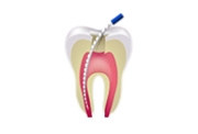 Root canal, treatment involved in full mouth reconstruction