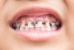 smile makeover candidate with severe teeth decay