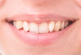 smile makeover candidate with slight teeth misalignment