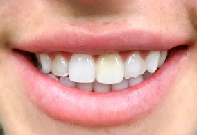 smile makeover candidate with uneven teeth