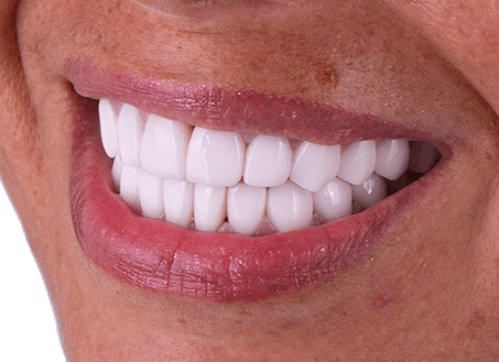 wonderful smile of composite veneers