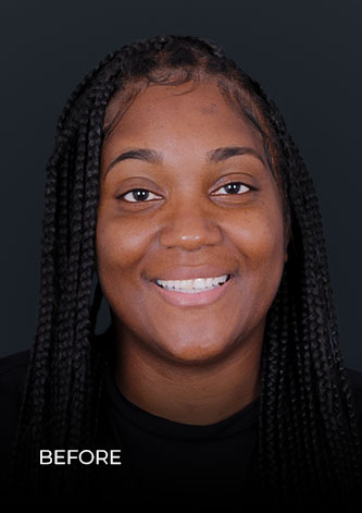 patient at Dental Work Mexico smiling before getting her lumineers