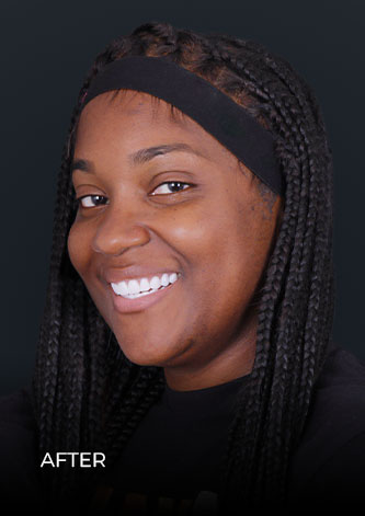 patient at Dental Work Mexico smiling after getting her lumineers