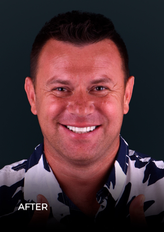 dental work mexico patient smiling after getting his crowns and bridges