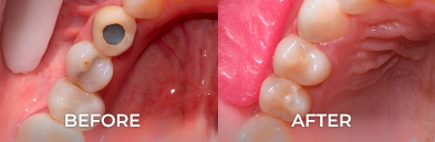 dental onlay amd inlay before and after