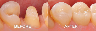 dental onlay before and after pictures