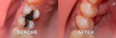 dental onlay amd inlay before and after