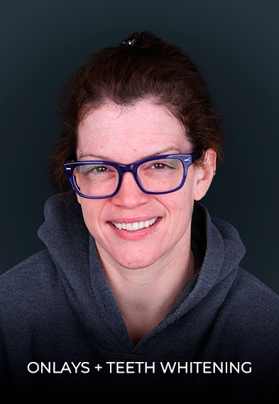patient smiling after getting dental onlays in Mexico