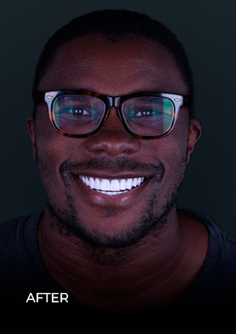 dental work mexico patien smiling before getting his same day crowns