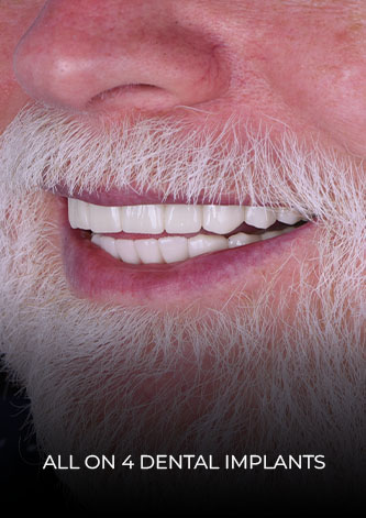 cds patient all on 4 dental implants sm