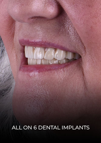 cds patient all on 6 dental implants smile