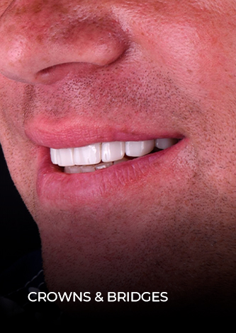 dental work mexico patient final restoration with crowns and bridges