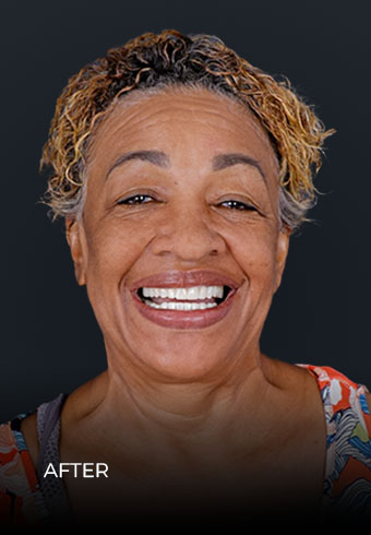 Smiling after getting all on 4 dental implants in Dental Work Mexico