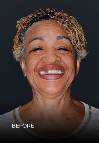 Smiling before getting all on 4 dental implants in Dental Work Mexico