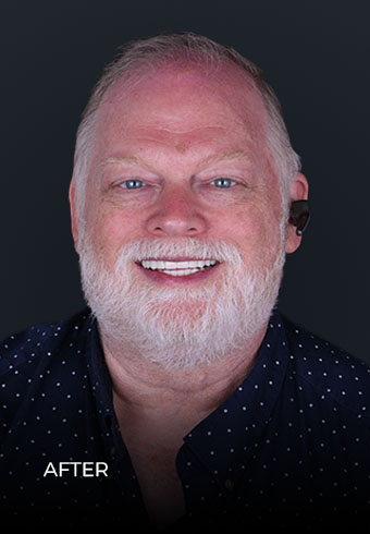 smiling after getting an all on 4 zirconia bridge in Dental Work Mexico