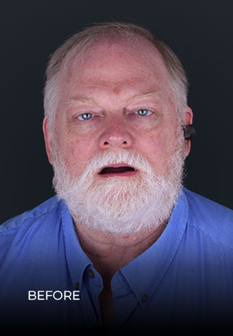 smiling before getting an all on 4 zirconia bridge in Dental Work Mexico