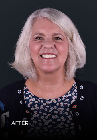 photo of CDS after her all on 6 implants in mexico