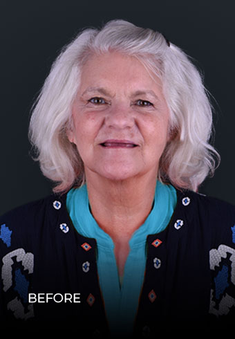 photo of CDS before her all on 6 implants in mexico