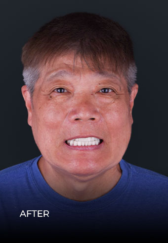 Showing his smile after getting dental bridges in Mexico