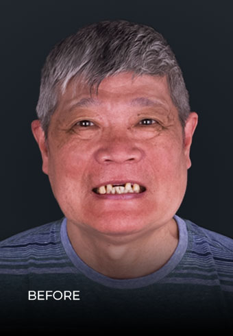 Showing his smile before getting dental bridges in Mexico